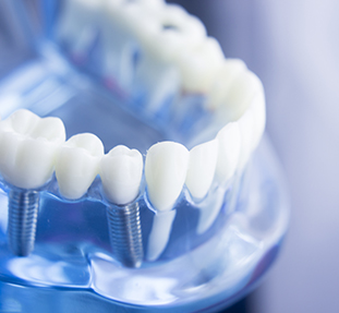 Dental Implants